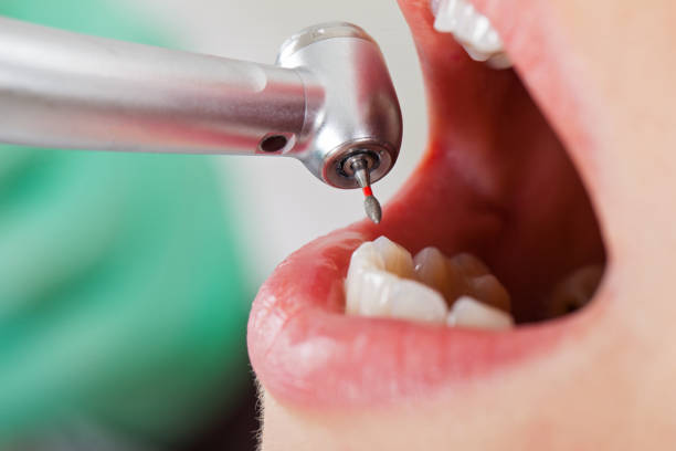 Best Emergency Dental Care for Abscessed Tooth in Rocky Mount, NC